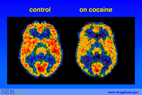 Even a small dose of cocaine affects the brain and can cause damage